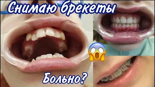 VLOG💕Снимаю брекеты