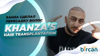 Ханза сделал пересадку волос | Russian famous singer Khanza's hair transplantation story with us !