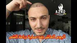 اليوم العاشر من عملية زراعة الشعر | ازالة القشور🙉 -Hair Transplant