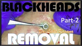 BIG BLACKHEAD REMOVAL/ANTI-ACNE TREATMENT PART-2