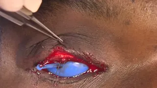 Surgery: Anterior Lamellar Recession &amp; Resection of Lash Follicles