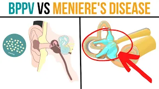 BPPV vs Meniere's Disease: What's the Difference & How to Improve