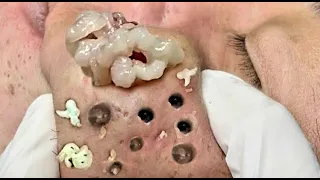 Relax Every Day With best video Loan Nguyen Spa 2022 ||#0155#acne #blackheads #whiteheads #pimple