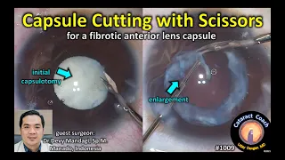 CataractCoach 1009: cutting a fibrotic lens capsule with scissors