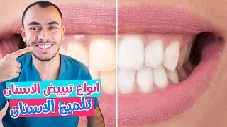 أنواع تبييض الاسنان و تبييض الاسنان المنزل تحت اشراف دكتور الاسنان ( بدون وصفات لتبييض الاسنان )