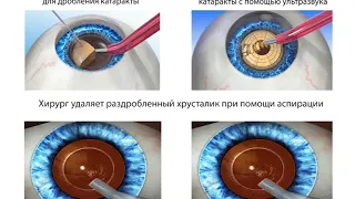 Лечение катаракты. Операция и удаление катаракты. Факоэмульсификация с имплантацией ИОЛ