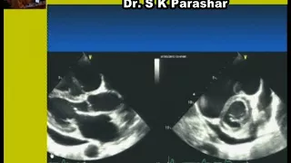 How not to miss a lesion by conventional echo  Part 1 Dr S K Parashar