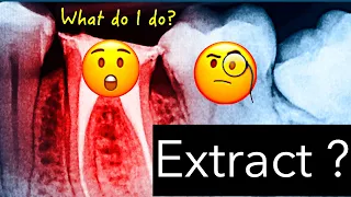 Should Root Canal Treated Teeth be Extracted - Oakville Dentist holistic dentistry