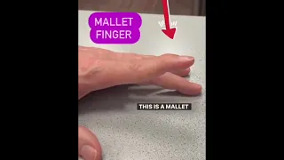 how to fix mallet finger injury #mallets  #physio #physicalfitness #exercise #rehab #pain