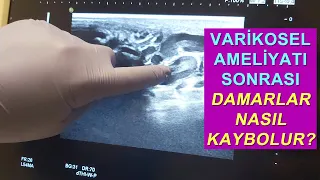 Varikosel Ameliyatı Sonrası Damarlar Nasıl Kaybolur? Varikosel Damar Çıkartma Tekniği 1. Ay İyileşme