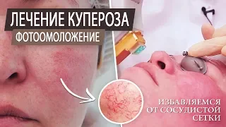 Фотоомоложение  Лечение купероза на лице  Чистка лица  Аппаратная косметология