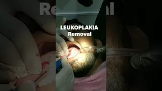 Leukoplakia removal#dentistry