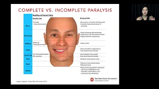 NF2 Accelerator Meetup: Facial Reanimation Surgery in NF2-related schwannomatosis