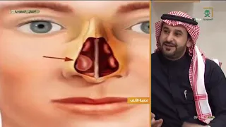 #صباح_السعودية | ماهي لحمية الأنف وأنواعها ؟ مع د. يزيد الغنيم - استشاري جراحة الوجه التجميلة