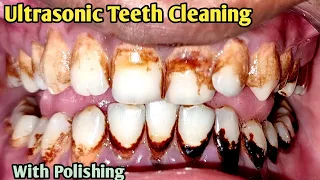 Heavy Stain Removal from Teeth | Teeth Cleaning by Doctor | Pan Masala Teeth Cleaning