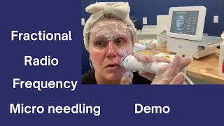 Fractional Radio Frequency Micro Needling For Home Use Demo