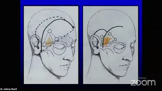 10 Bases of Craniotomies