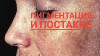 АПТЕЧНАЯ ТРАВА ОТ ПИГМЕНТАЦИИ. Пигментация и Постакне. Гомеопатия от пигментации.