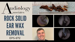 ROCK SOLID EAR WAX REMOVAL - EP672