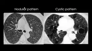 Diffuse lung diseases Dr Mamdouh Mahfouz