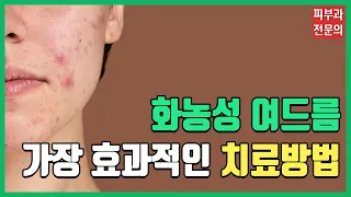 화농성여드름 치료, 가장 효과적인 치료방법은?💡