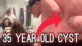 35 YEAR OLD Cyst | Satisfying HARD POP and BLACKHEAD Removal | #TheBubbaArmy #blackheadremoval