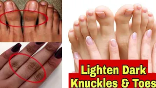 How to lighten dark knuckles and toes at home | remedy for lighten dark knuckles and toes Urdu Hindi