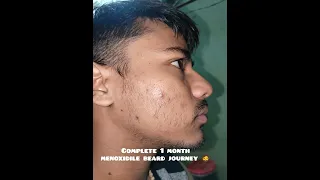 complete 1 month minoxidile  beard journey. week 4 and 30days. ||minoxidil||🧔