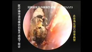 External auditory canal cholesteatoma with very narrow entrance 20240229