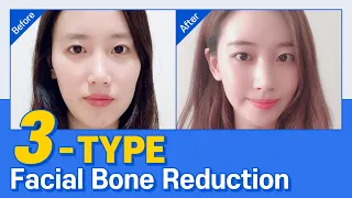 ■Facial Contouring Recovery Process 1■ [Before & After]
