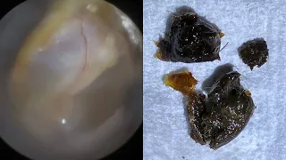 116 - Large Ear Wax Plugs Removed using WAXscope®️