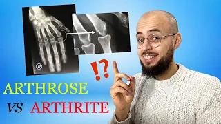 Arthrose et arthrite : les différences (causes, symptômes, traitements)