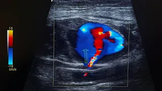 iatrogenic femoral artery pseudoaneurysm after cardiac catheterization