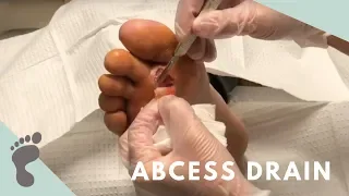 Athlete's Foot Leads to Abscess Drain