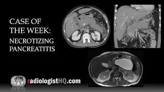 Case of the Week: Necrotizing Pancreatitis (CT & MRI)