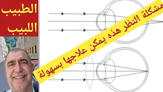 ايهما اخطر قصر أم بعد النظر؟؟