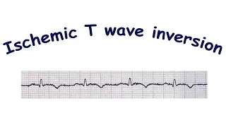 Mechanism of ischemic T wave inversion