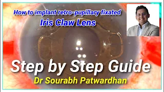 Retropupillary fixated Iris Claw Lens- Step by step Guide Dr Sourabh Patwardhan Best Teaching vid 4K