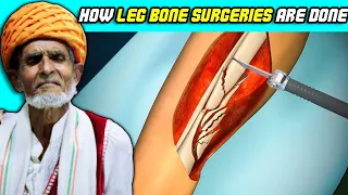 Villagers React To HOW LEG BONE SURGERIES ARE DONE ! Tribal People React To LEG BONE SURGERIES