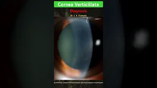 Cornea Verticillata. Diagnosis’.