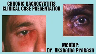 CHRONIC DACROCYSTITIS Clinical Case Presentation