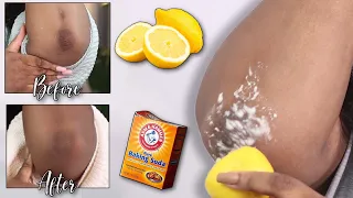 HOW I LIGHTENED MY DARK ELBOWS QUICKLY - Baking soda and lemon
