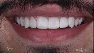 COMPOSITE RESIN  VENEERS SMILE MAKEOVER