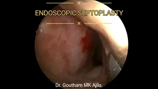 Endoscopic Septoplasty for Deviated septum Dr. Goutham MK Ajila