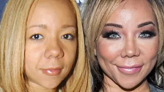 The TRUTH About Tiny Harris' Plastic Surgery Procedures 🥴