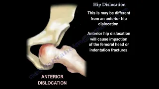 Hip Dislocation. what is hip dislocation and how do we deal with it ? how urgent it is ?