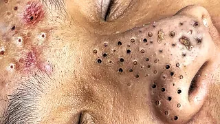 Blackhead Removal With Sac Dep Spa @1000343