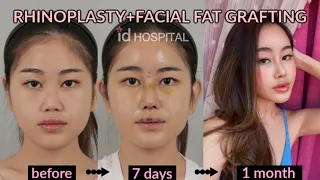 Rhinoplasty and Fat grafting review VLOG  ID hospital