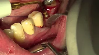 Piezosurgery Mectron Implant placement