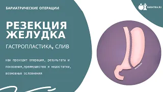 Резекция желудка (гастропластика, слив). Все что нужно знать об операции